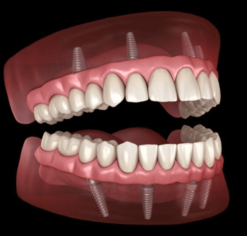 All-on-4® Dental Implants