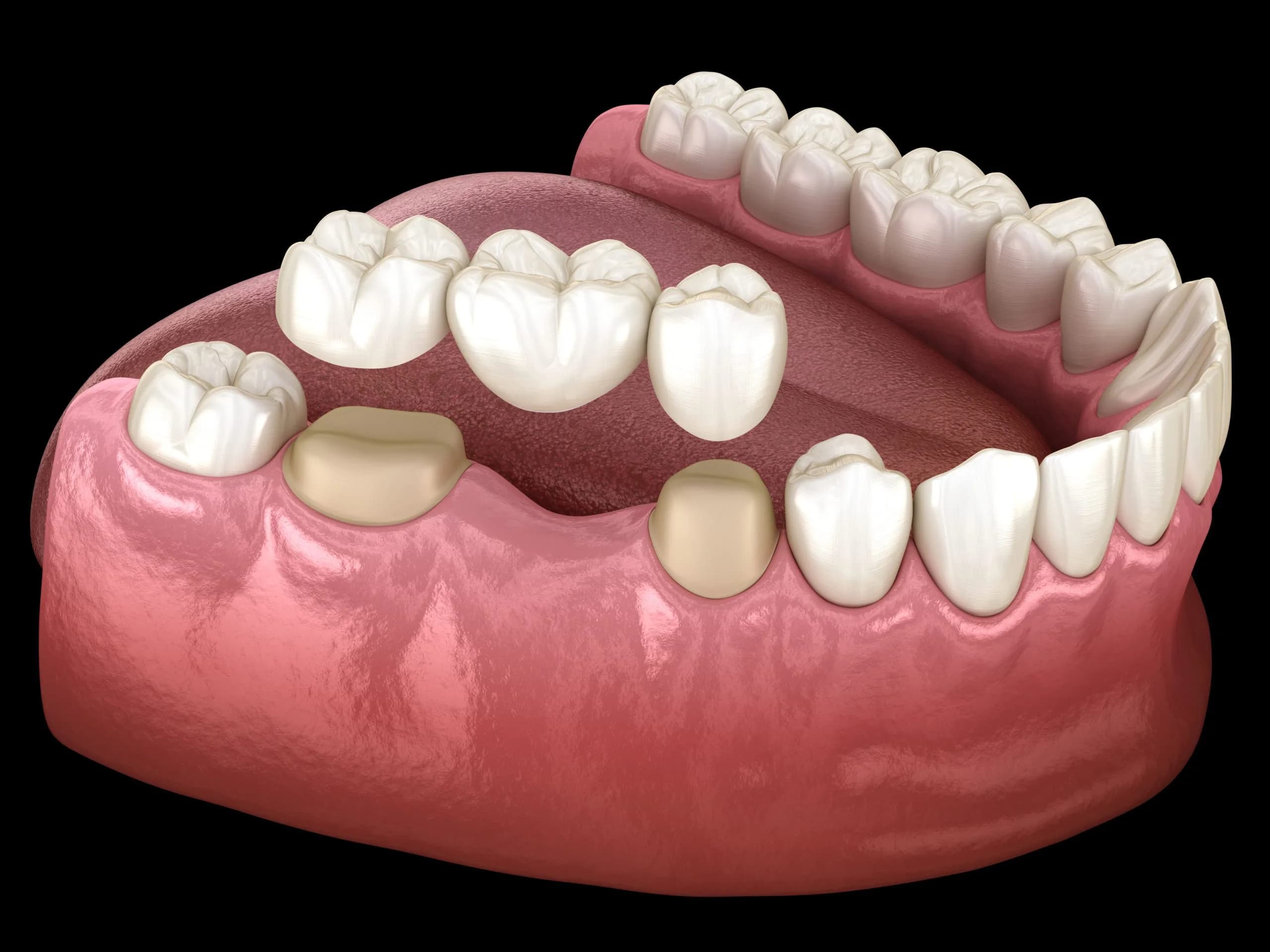 Dental Crowns and Bridges at Tribeca Dental Studio