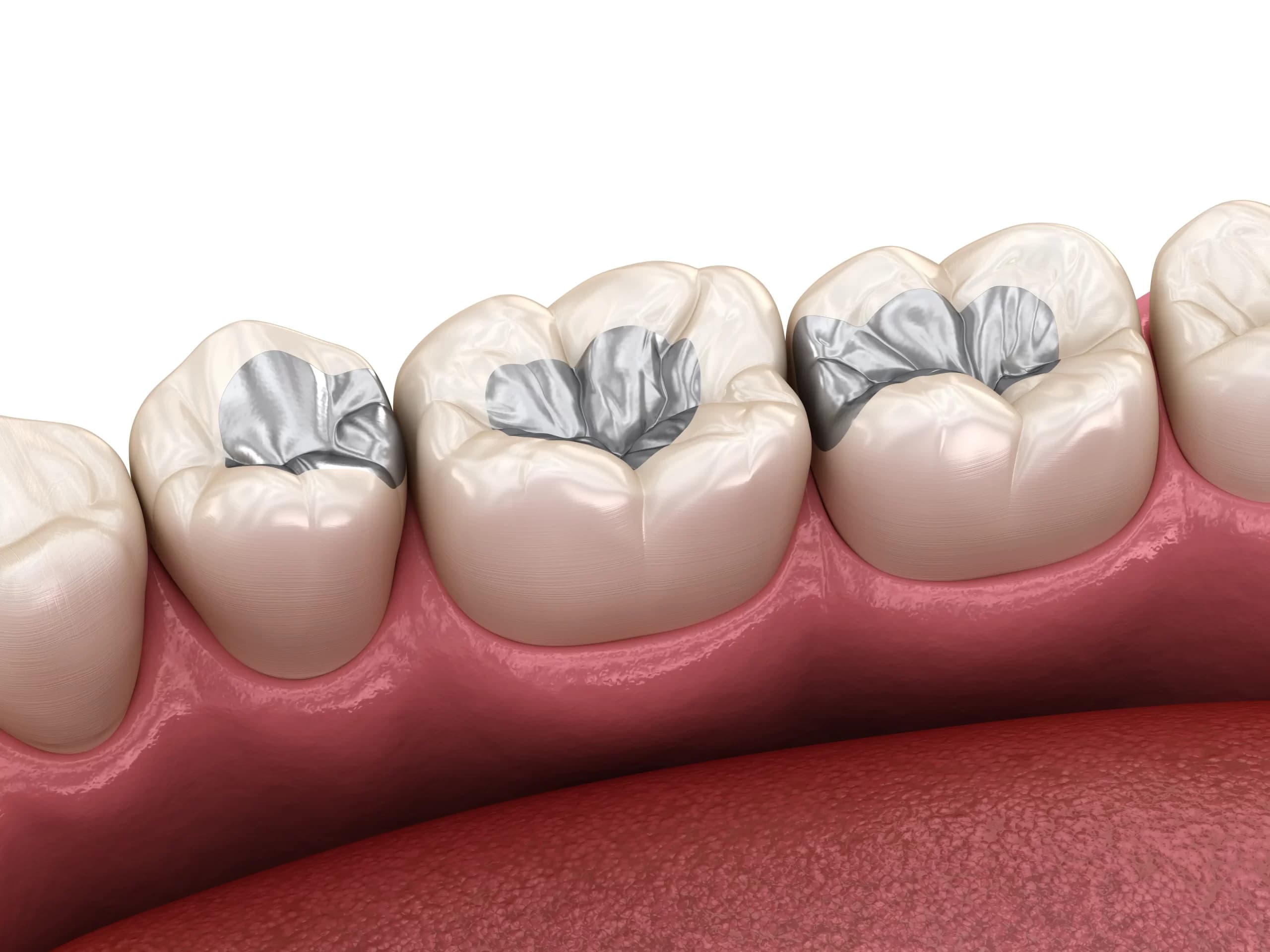 Dental Fillings at Tribeca Dental Studio NYC