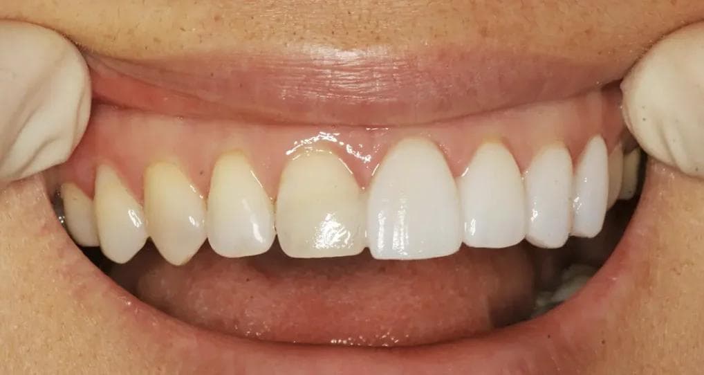 The Ultimate Guide to Veneers vs Crowns