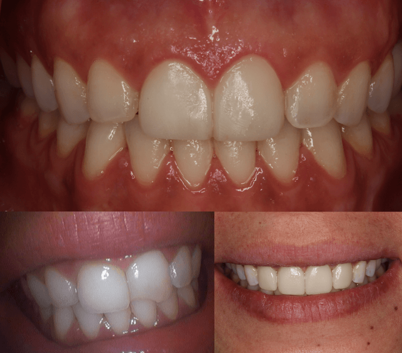 Veneers in NYC: Cost, Types, Process & Best Dentist in Manhattan