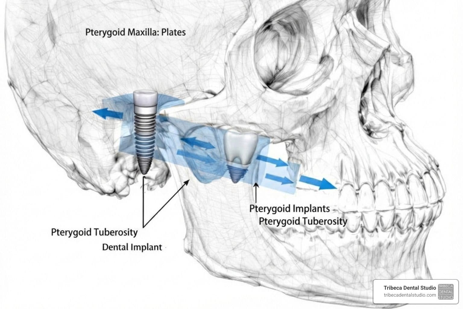 Mastering Pterygoid Implant Placement: An Anatomical Guide