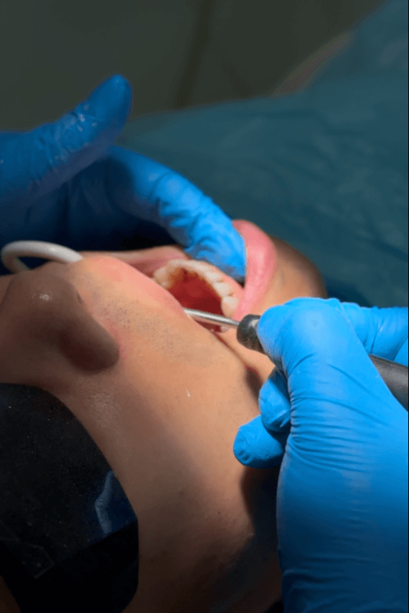 Cheat Sheet to Early Gum Disease Signs & Deep Cleaning