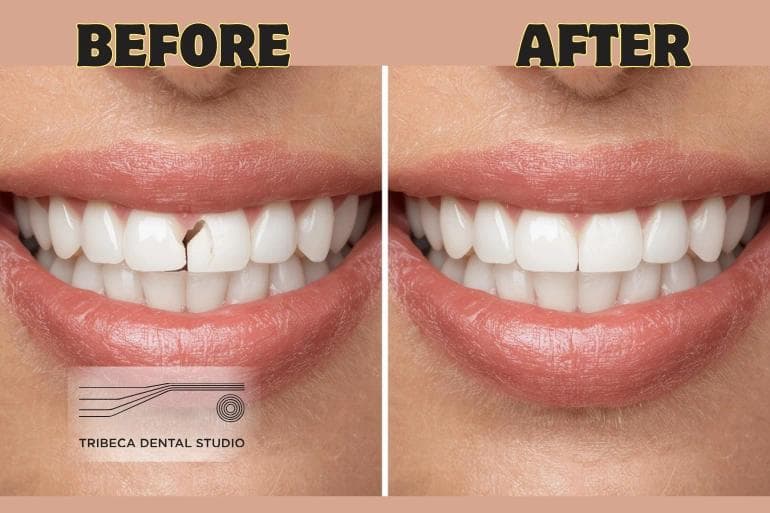 Cosmetic Dentistry Options to Repair a Chipped Tooth: Effective Smile Restoration Solutions