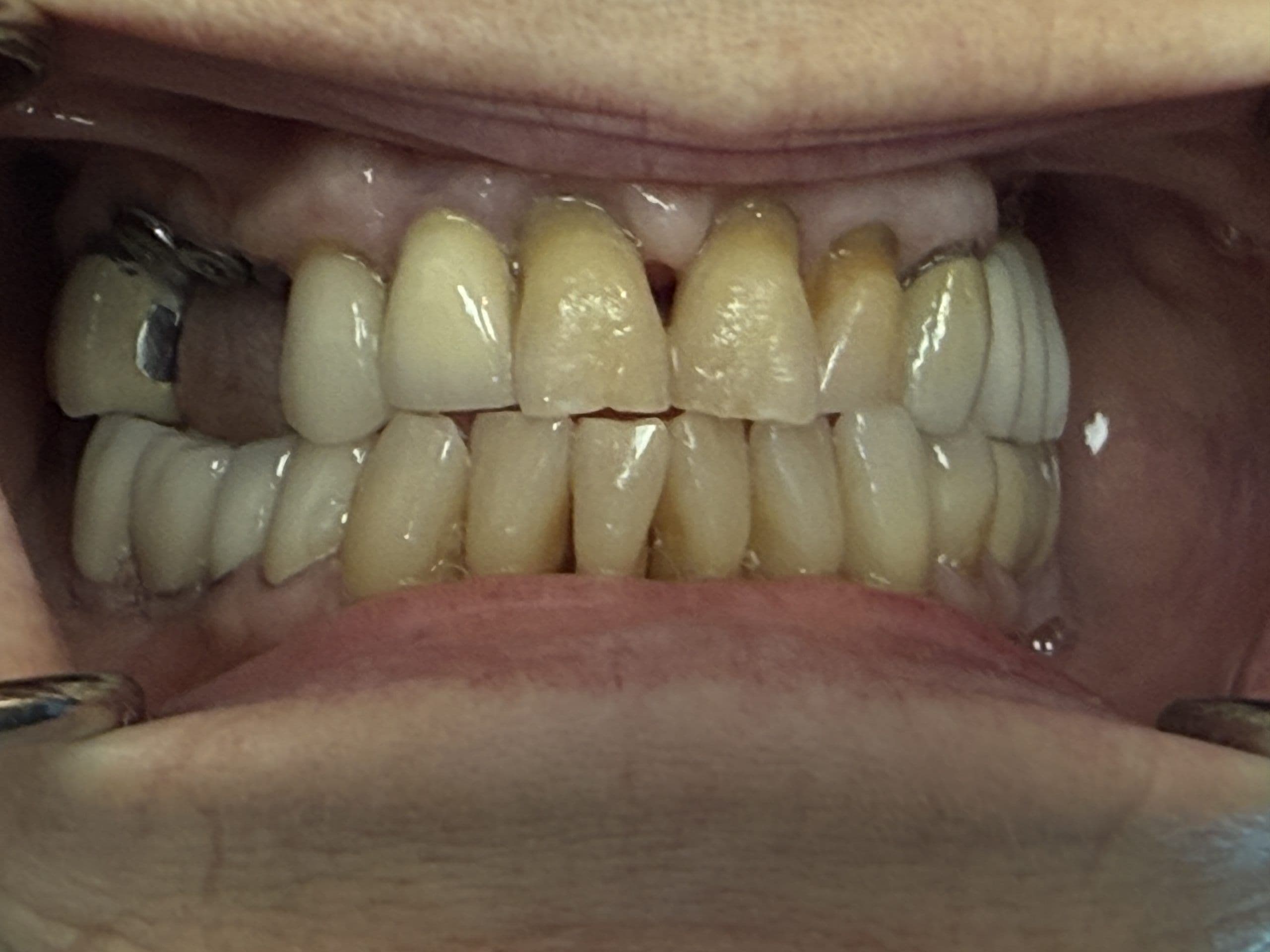 What Is an Implant Temporary Bridge?