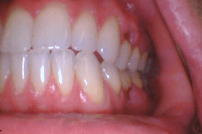 Why Do Some People Get Gum Recession Even With Good Cleaning?