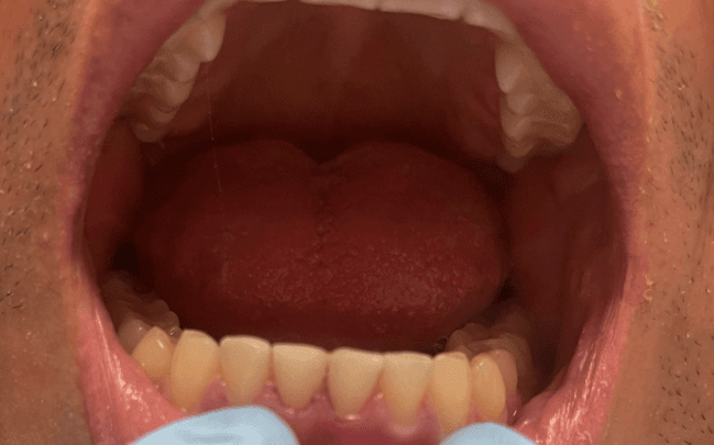 Dental Fillings in NYC – Natural, Durable & Aesthetic Restorations at Tribeca Dental Studio
