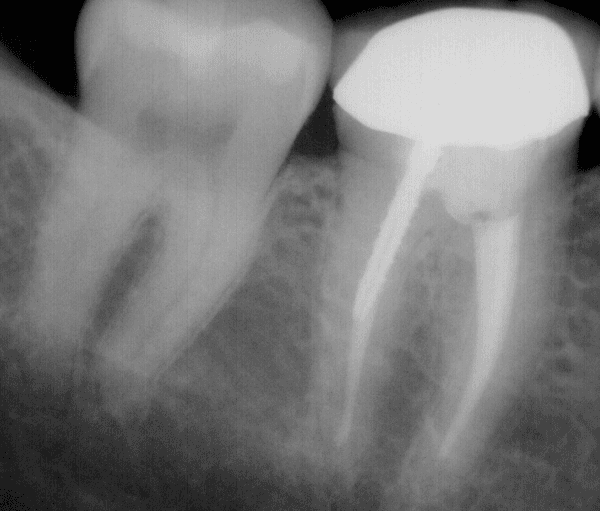 How Long Do Root Canals Last? Longevity, Success Rates & Expert Tips