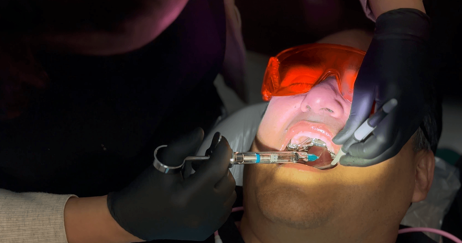 Cavity Filling 101: From Numbing to a New Smile