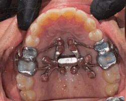 Can MARPE Alone — or Combined With NightLase — Fix Sleep Apnea? (NYC Guide)