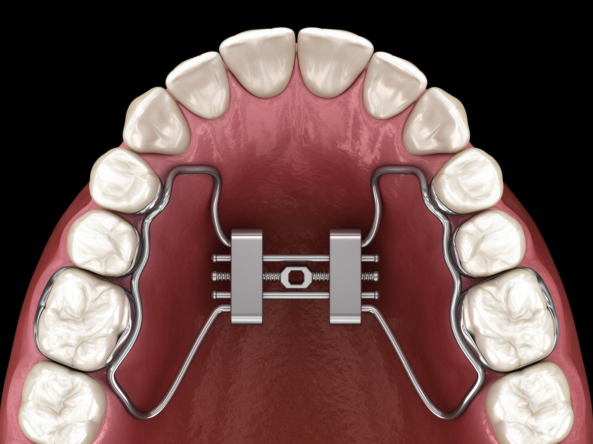 Dr. Reem Abdulrahman Palatal Expansion MARPE MSE Tribeca Dental Studio
