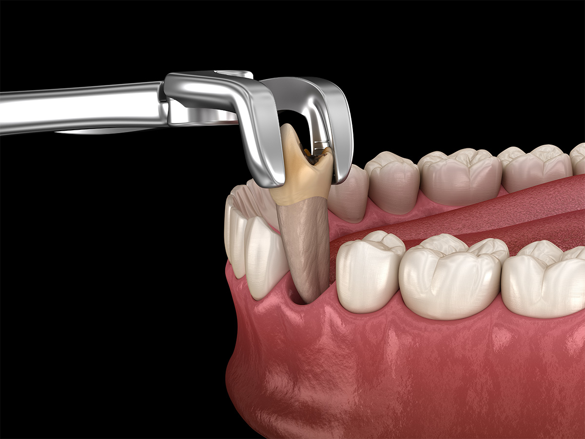 Wisdom Tooth Extraction and Gentle Oral Surgery in Tribeca NYC
